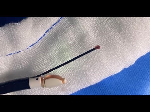 ENDOBRONCHIAL ULTRASOUND - TRANSBRONCHIAL CRYO NODE BIOPSY - EBUS TBCNB