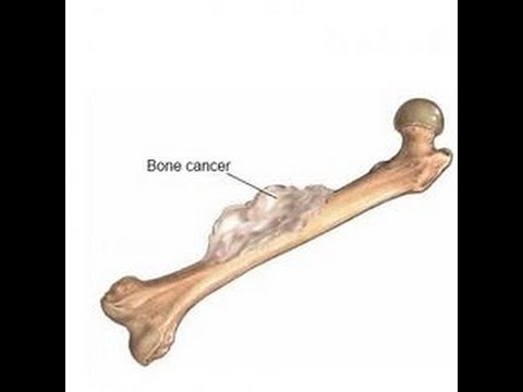 Comment traiter et guérir le cancer des os