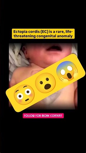 Ectopia cordis rare congenital anomalie 😮😱#nursing #shorts