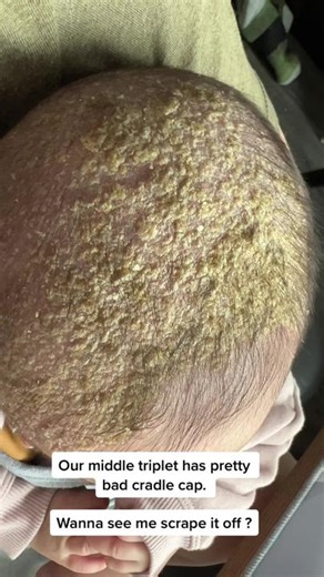 Triplet's Bad Cradle Cap: Removal Process