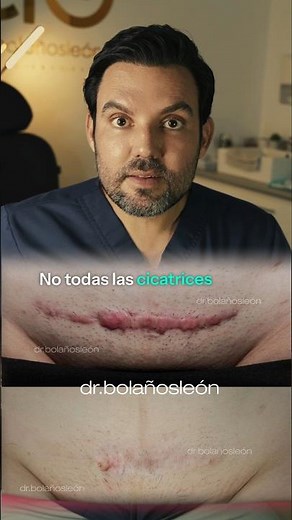 Tratamiento de cicatrices Hipertróficas y Queloides