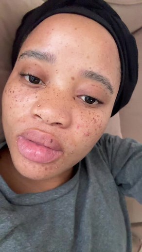 Understanding Contraceptives for Hormonal Acne Management