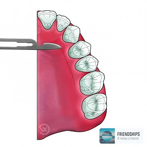3.1K views · 121 reactions | How to harvest connective tissue graft. Credit @dr_francois_vigouroux #Dentistry #LearningTips | Bites & Braces Dental | Facebook