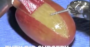"They Did Surgery on a Grape" Meme Began With Legally Suspect Medical Tool