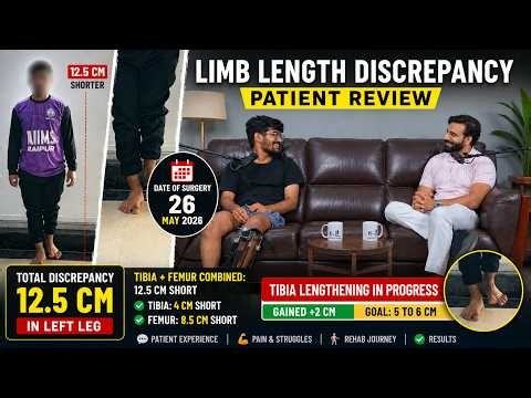 12.5 CM Limb Length Discrepancy Correction | Pain, Recovery & Lengthening Progress Review