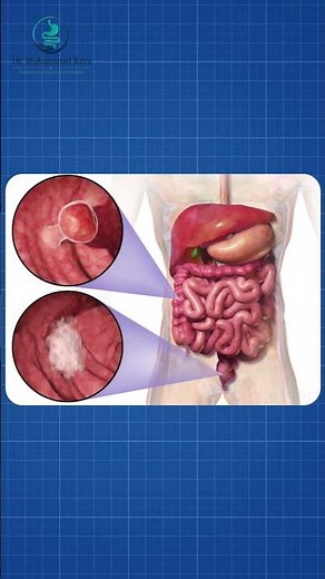 Blood in Stool? Common Causes & When to See a Gastroenterologist | Don't Ignore These Signs