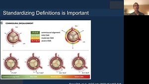 Refinements in TAVR: Cusp Overlap and Commissural Alignment