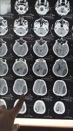 chronic subdural hematoma | Dr Naimat shar | #neurosurgeon #doctor #hospital