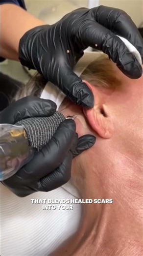 Scar Camouflage Tattoo: Hide Scars Permanently!