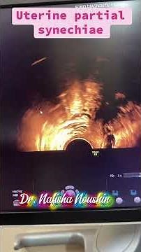 uterine partial synechiae #ultrasound #infertility