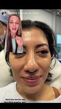 Lip Lift
