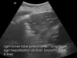 CASE 744 lung ultrasound pneumonia lung tissue sign hepatization air fluid bronchogram B lines