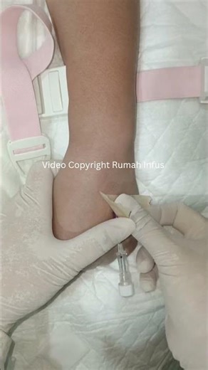 IV Cannulation