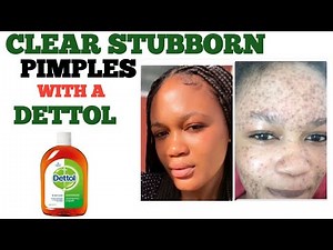I Used Dettol on My Acne for 1 Week & This Happened