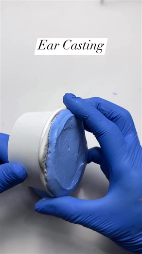 Ear Casting for Custom Ear ProsthesisEar casting gently captures the exact shape of the patient’s ear area using a safe impression material. This detailed mold becomes the foundation for creating a natural-looking silicone ear prosthesis.It ensures comfort, accuracy, and restored confidence—made with care and compassion for every patient. #CustomEarProsthesis #EarCastingProcess #MicrotiaCare #FacialProsthetics #RestoringConfidence #PatientCareWithCompassion #SakuraProsthetics #entdoctors | Sakur