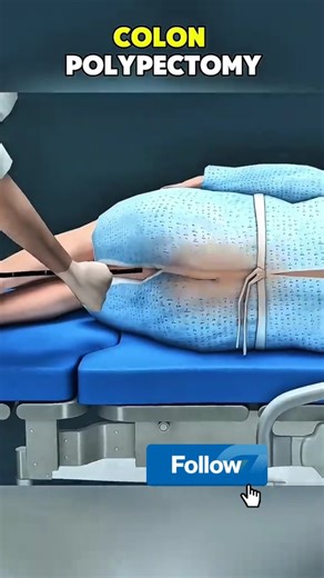 |'m Ŋurse on Instagram: "Colon Polypectomy"