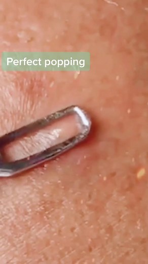 #greenscreenvideo #yoyomcn #pimplepopping #pimpleremover #zitpopper #extractions #cystpopping perfect popping