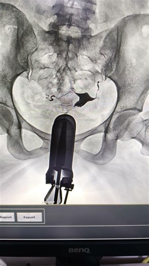 H.S.G. procedure