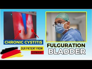 Chronic Cystitis Solved – German Patient’s Journey | Watch the Bladder Fulguration Procedure