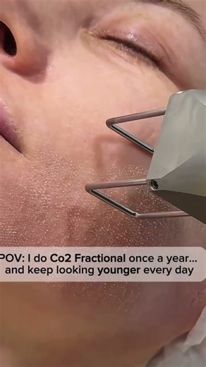 c02 fractional laser #duet #satisfying