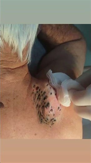 Watch These Satisfying Cyst Popping Clips 69