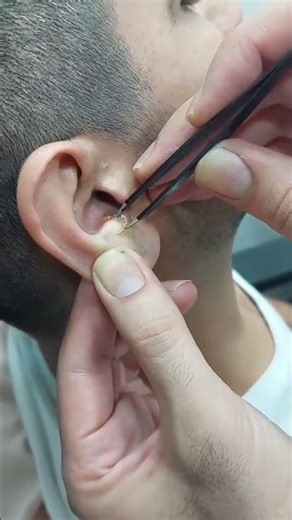 Blackheads on ear Removal!! 🥴👂🧐
