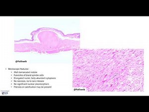 Oesophagus - Leiomyoma: Microscopy (Talking slide)