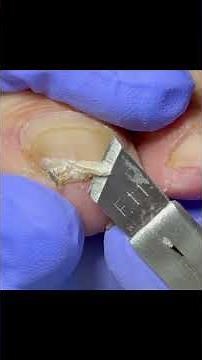 Ingrown Toenail Trimming - Professional Pedicure #satisfying