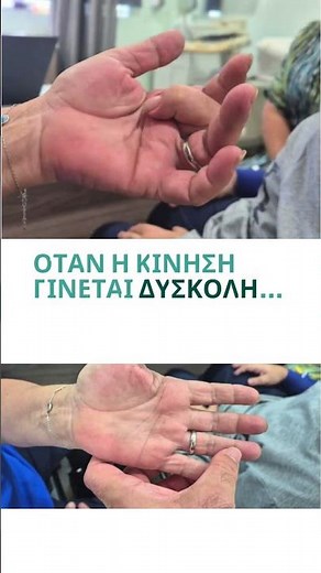 👉 Εκτινασσόμενος Δάκτυλος & Νόσος Dupuytren: Όταν το δάχτυλο “κλειδώνει”👉