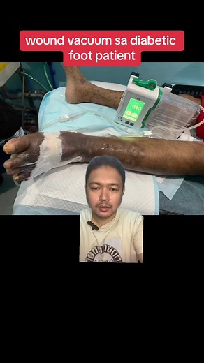 Wound Vacuum Treatment for Diabetic Foot Care
