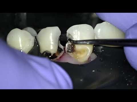 injectable composite restorations