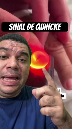 Quincke's sign: semiological finding of aortic insufficiency #cardiology