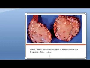 tumeurs non épithéliales première partie les hémopathies malignes