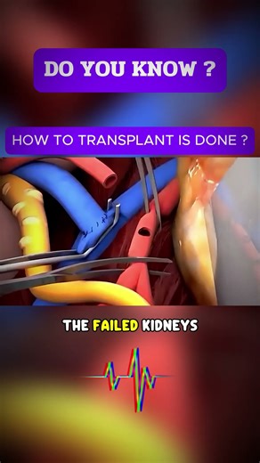 How to Transplant Kidney Surgery Is Done Step by Step #kidney #kidneytransplant