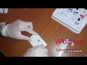 شرح طريقة عمل تحليل widal test