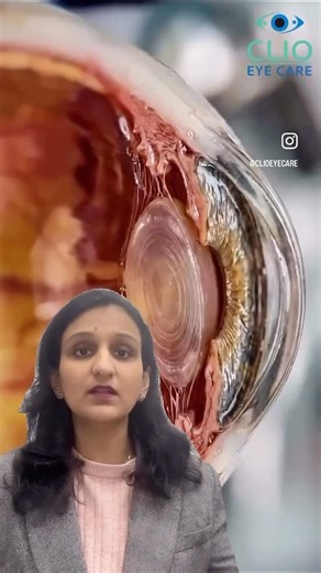 How Cataract Develops in Eye ? And Science behind Cataract Surgery!