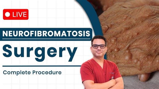 Neurofibromatosis Treatment | Live Removal Procedure Explained | SkinQure