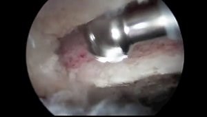 Arthroscopic Reduction and Internal fixation of Symptomatic Os Acromiale