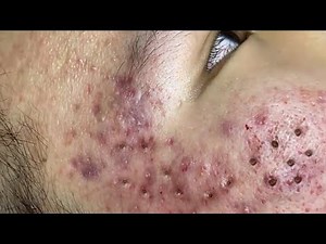 Loan Nguyen Acne Treatment 65k