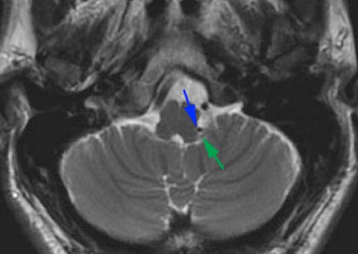 Glossopharyngeal Neuralgia | Expert Surgeon
