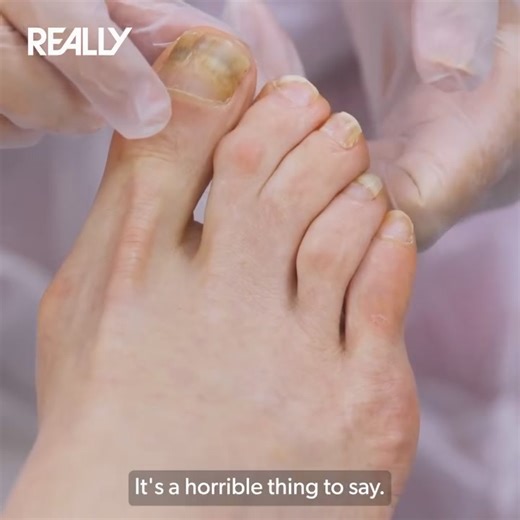Webbed toes and a fungal nail infection get expert care from Marion in todays episode of #TheBadFootClinic 💪🦶 Everyone should leave the clinic with a smile🙂💯 Featuring. @foot.ankle, always there for the expertise help!❤️ Every Wednesday 9pm on @reallytvchannel! Steam any episodes you’ve missed so far on @discoveryplusuk! #verrucas #thebadfootclinic #podiatri #podiatria #podiatrist #london #tvshow #corn #callus #feet #verruca #verrucaremoval #viral #trending | Miss Foot Fixer