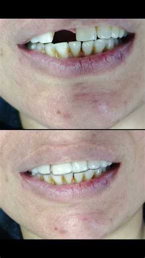 Tooth extraction and temporary replacement all on same day using Modified Essix retainer.
