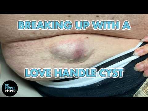 Breaking Up with a Love Handle Cyst