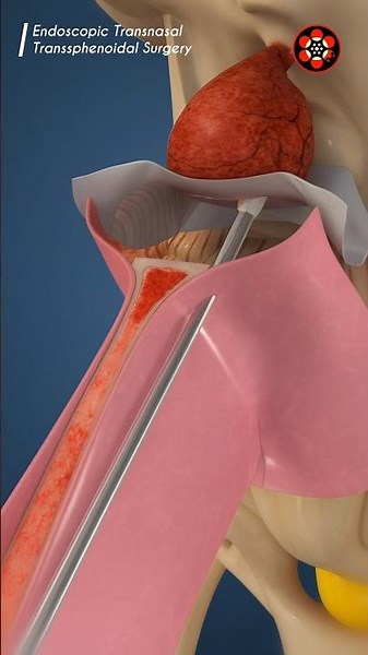 Endoscopic Transnasal Transsphenoidal Surgery #3danimation
