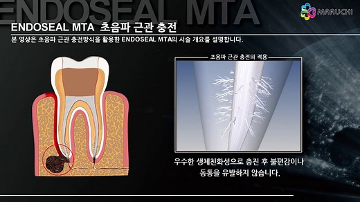 MARUCHI _ ENDOSEAL MTA premixed injectable paste ver.KOR