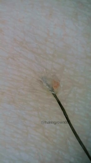 #blackhead #satisfying #satisfyingvideo #ingrownhair #ingrownhairpull #tweezers