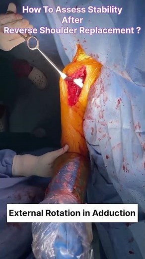 How to assess stability after reverse shoulder replacement | Orthopedic Surgery Guide