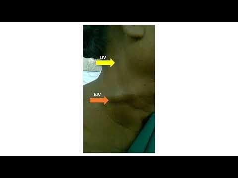 External and Internal Jugular vein pulsations