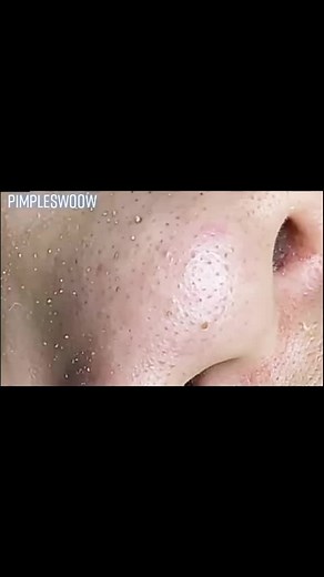 pimpleswoow on TikTok