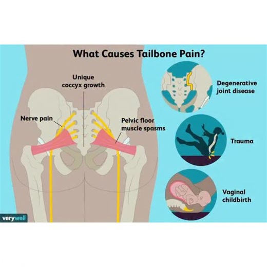 Coccydynia, aka tailbone pain, is a common injury from falls or constant pressure on the coccyx. The glute max, levator ani, and the coccygeus muscles attach to the coccyx. NKT often finds one glute max overworking and the other underworking, as well as the levator ani/coccygeus overworking and the glute max underworking. This article presents a conservative approach to coccydynia. https://tinyurl.com/2s38xepc (Link in profile). #nkt #neurokinetictherapy #tailbonepain #coccydynia | NeuroKinetic 